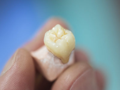 Dental Crowns