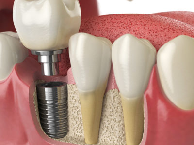 Dental Implants