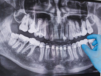 Dental Xray