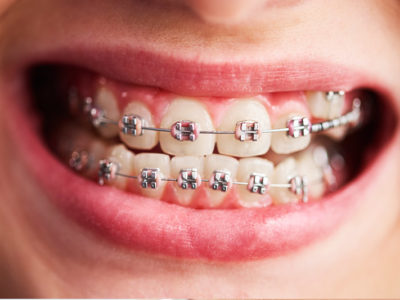 Invisalign