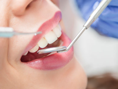 Seamless Dental Bonding: Enhance Your Smile with Confidence!