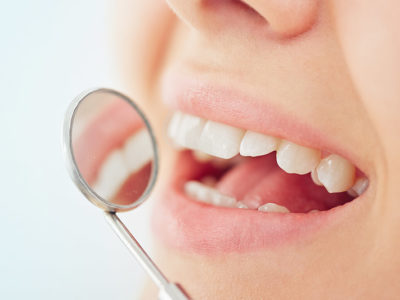 dental-whitening