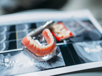 dentures