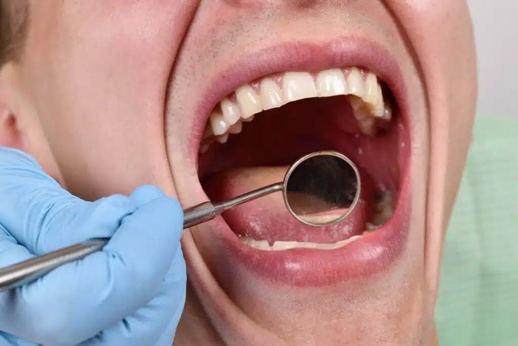 man's mouth wide open being looked at with magnifying