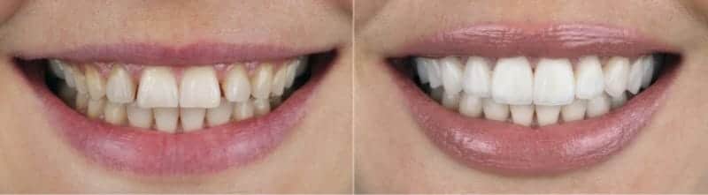 before and after pictures of dental veneers