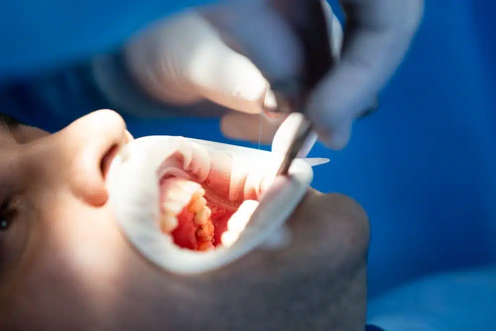 patient receiving dental surgery. Bleeding in the top left of his mouth