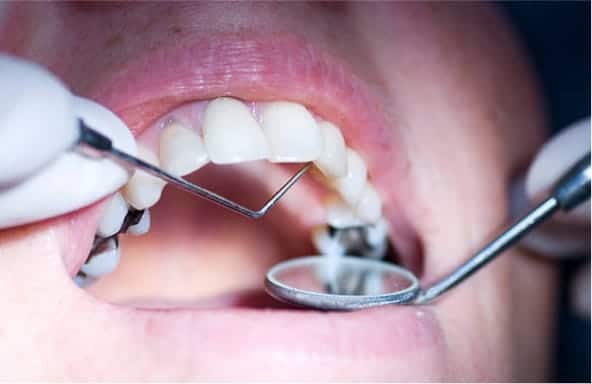 A close-up image of a tooth with a freshly placed dental filling, highlighting the restored area.