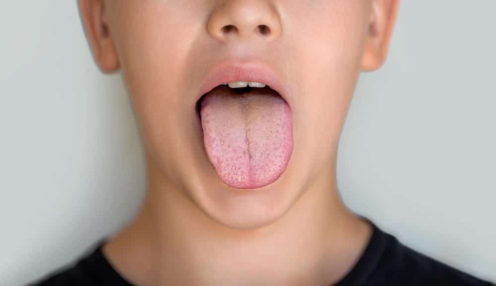 drymouth
